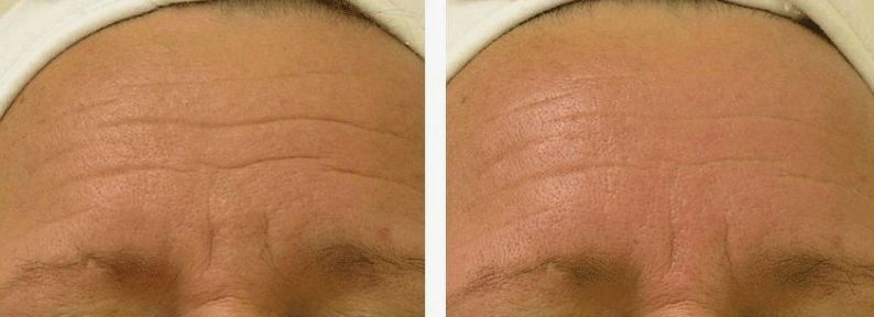 Before & After